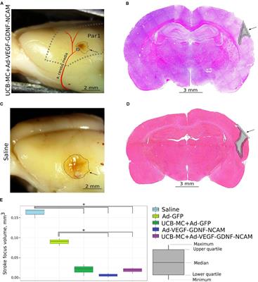 Triple-Gene Therapy for Stroke: A Proof-of-Concept in Vivo Study in Rats